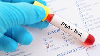 Prostat Kanseri Teşhisinde 55 Yaş Öncesine PSA Testi Artık Önerilmiyor